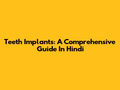 Teeth Implants: A Comprehensive Guide In Hindi